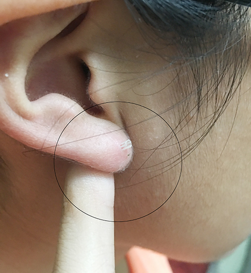 耳洞塑膠管